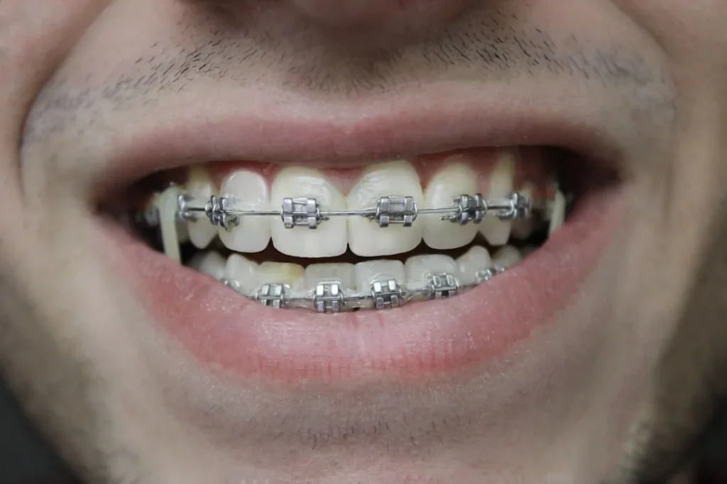 A teenager with orthodontic braces smiling
