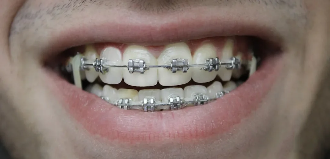 A teenager with orthodontic braces smiling
