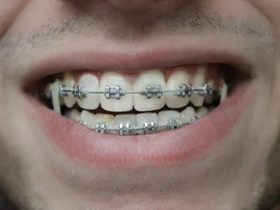 A teenager with orthodontic braces smiling